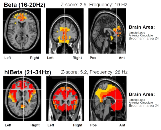 Imagerie source sLORETA qEEG